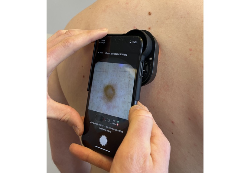 Tech1 DermKit on skin, cropped