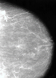 mammogram