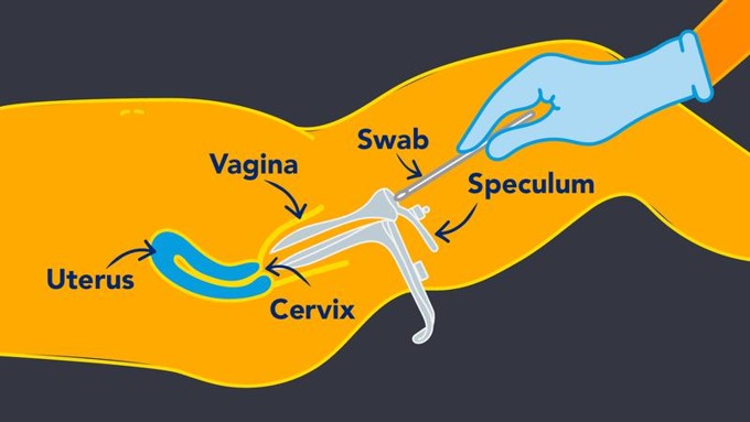 drawing of a pap smear