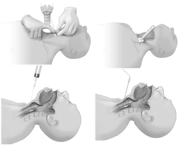 Closed Cricothyrotomy