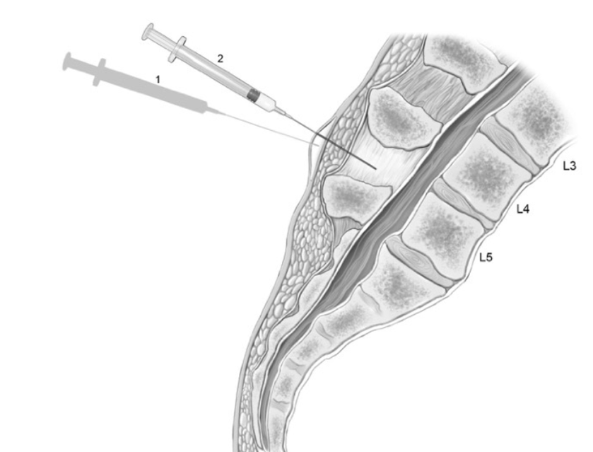 Picture of lumbar puncture with needle