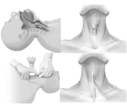 Open Cricothyrotomy