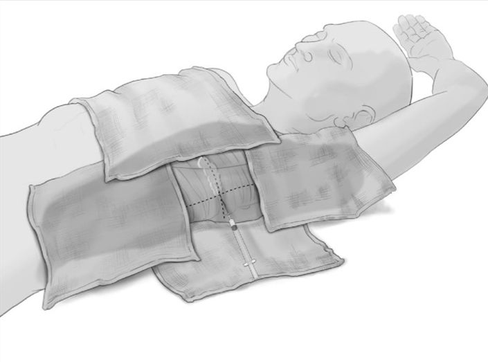 Tube Thoracostomy