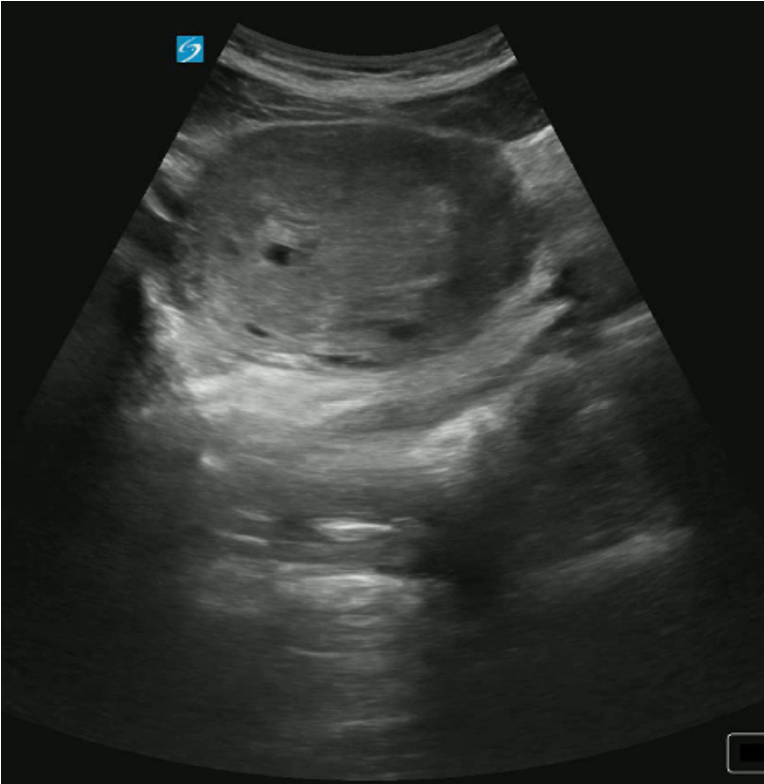 patultrasound2